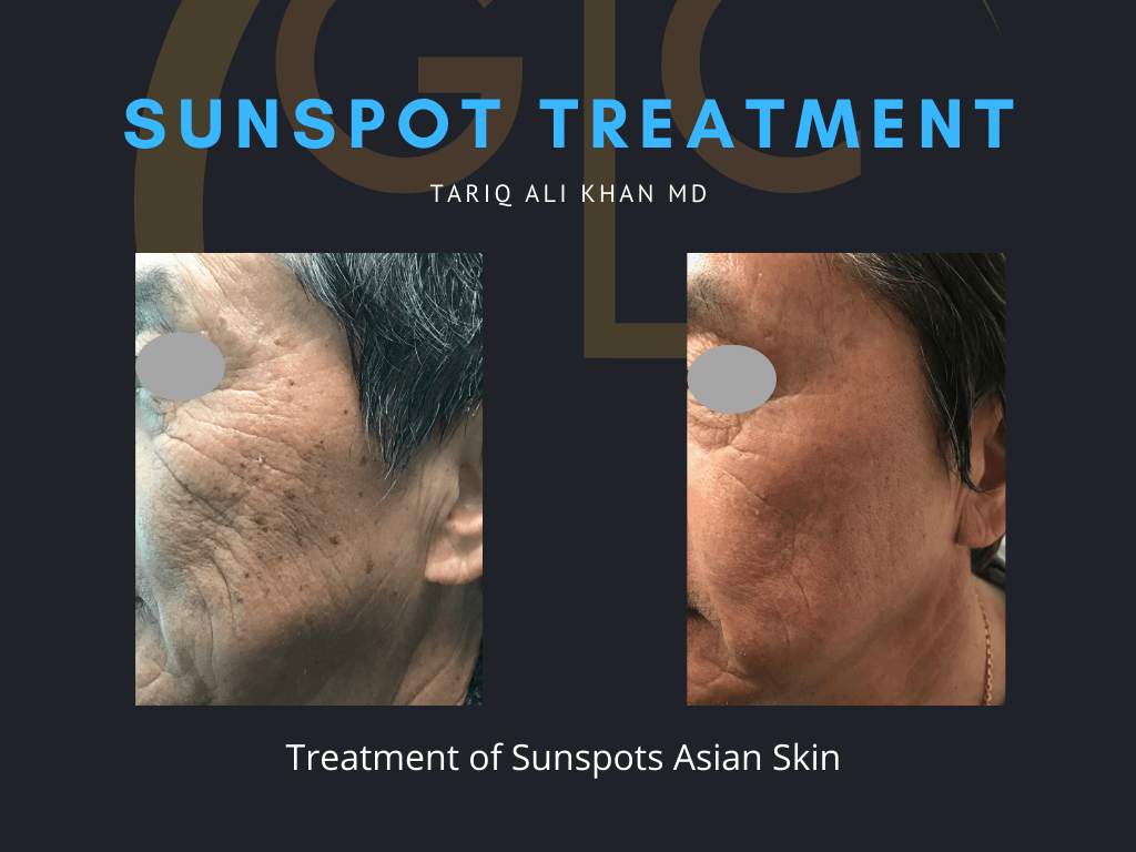 Gentle Care Laser Tustin Before and After picture - Sunspot treatment